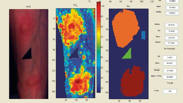 來自諾丁漢大學的高光譜圖像，通過將光線照射在組織表面并準確測量氧氣水平并生成血氧飽和度圖而得出，以方便臨床研究人員和醫(yī)生的工作。